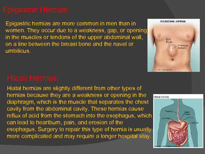 Epigastric Hernias: Epigastric hernias are more common in men than in women. They occur