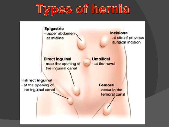 Types of hernia 