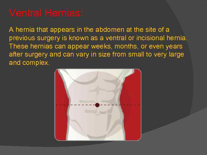 Ventral Hernias: A hernia that appears in the abdomen at the site of a