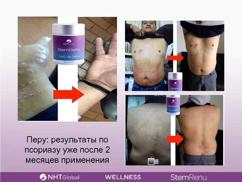 Перу: результаты по псориазу уже после 2 месяцев применения 