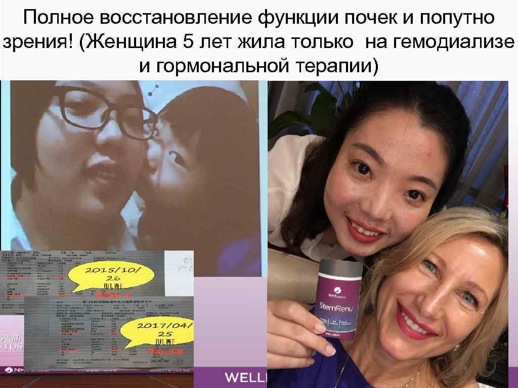 Полное восстановление функции почек и попутно зрения! (Женщина 5 лет жила только на гемодиализе