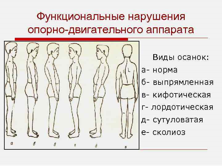 Нарушение ода. Синдромы поражения опорно-двигательного аппарата. Заболевания опорно-двигательного аппарата: нарушения осанки. Заболевания опорно-двигательного аппарата у детей. Осанка опорно двигательная система.