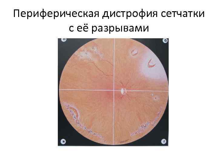 Периферическая дистрофия сетчатки с её разрывами 