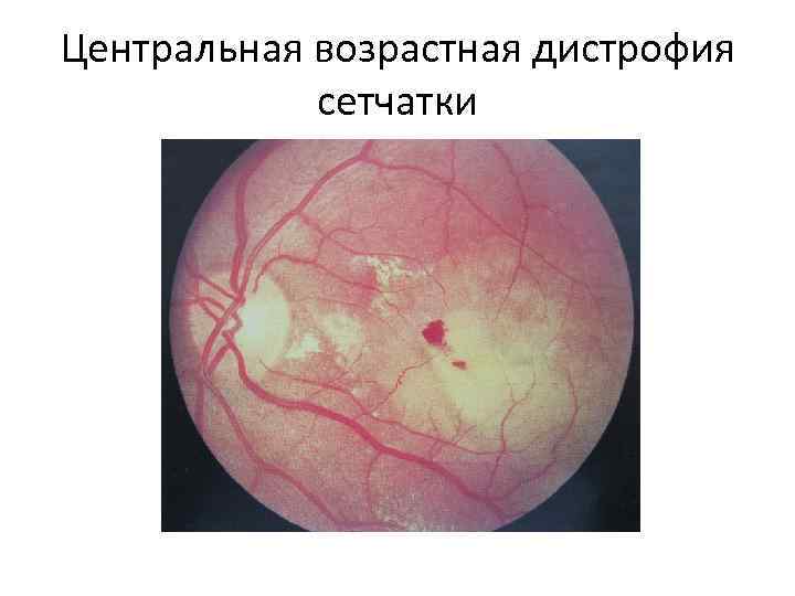 Центральная возрастная дистрофия сетчатки 