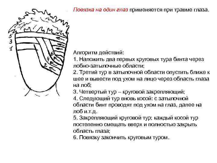 Повязка на один глаз применяется при травме глаза. Алгоритм действий: 1. Наложить два первых