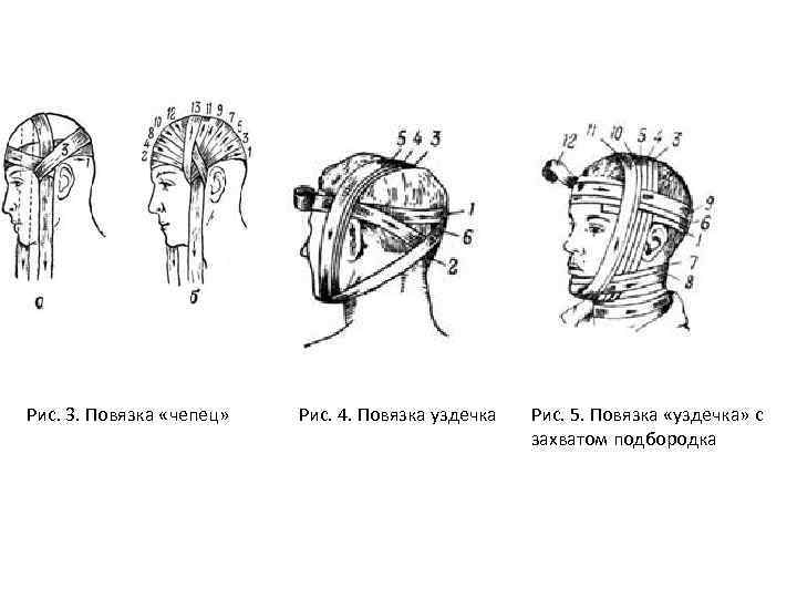 Рис. 3. Повязка «чепец» Рис. 4. Повязка уздечка Рис. 5. Повязка «уздечка» с захватом