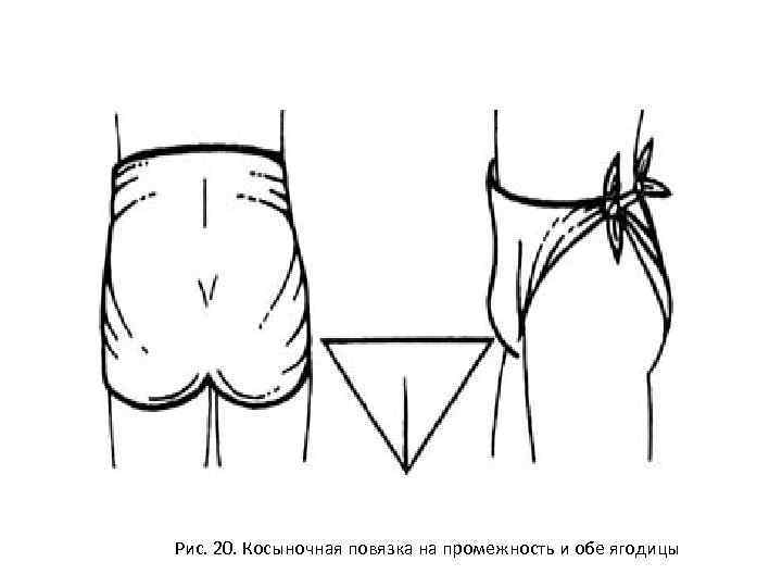Рис. 20. Косыночная повязка на промежность и обе ягодицы 