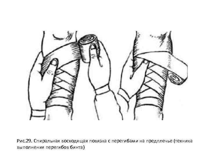 Спиральная повязка. Спиральная повязка с перегибами на предплечье. Спиральная с перегибами повязка характеристика. Методика наложения спиралевидной повязки.. Спиральная повязка без перегибов.