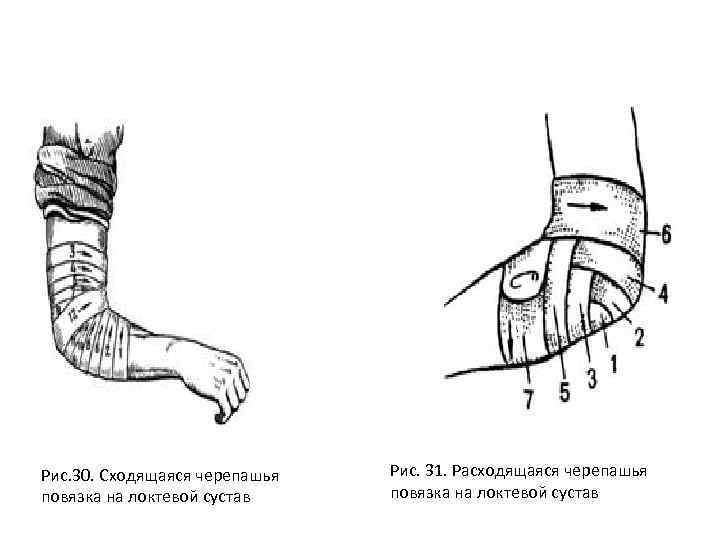 Рис. 30. Сходящаяся черепашья повязка на локтевой сустав Рис. 31. Расходящаяся черепашья повязка на