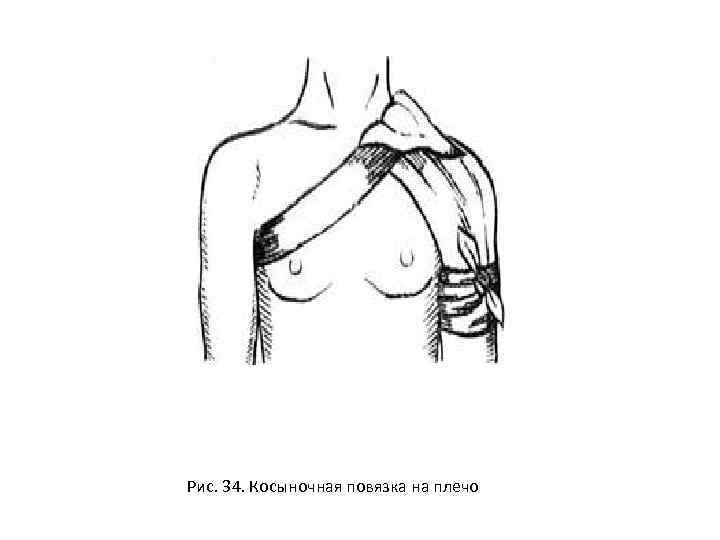 Рис. 34. Косыночная повязка на плечо 