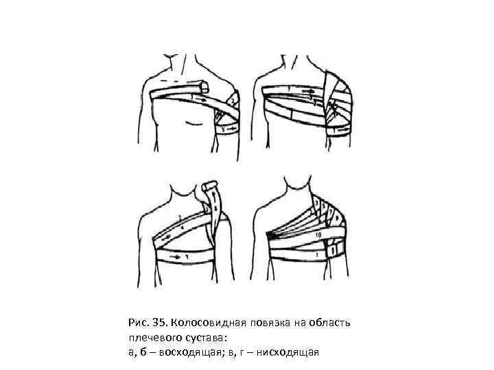 Колосовидная повязка