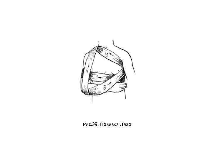 Рис. 39. Повязка Дезо 