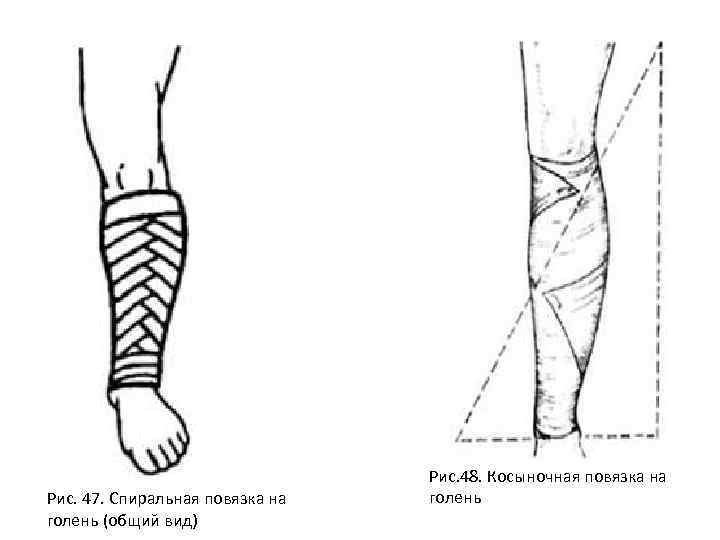 Спиральная повязка