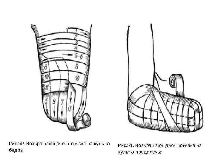 Повязка на культе