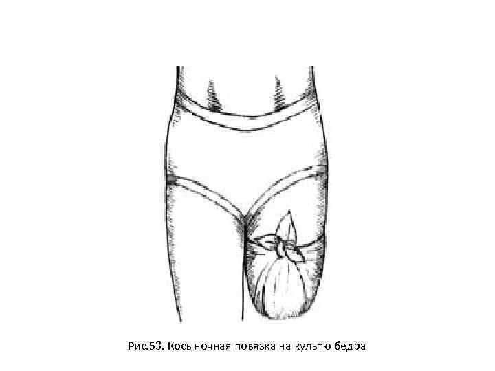 Повязка на культе