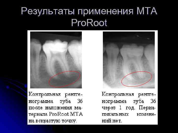 Результаты применения MTA Pro. Root 