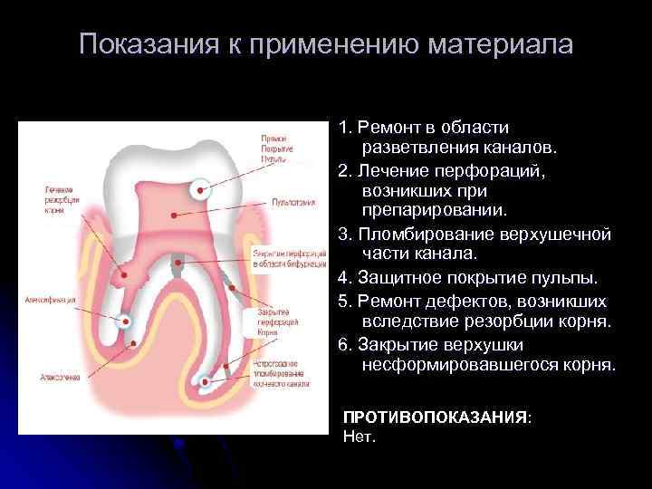 Показания к применению материала 1. Ремонт в области разветвления каналов. 2. Лечение перфораций, возникших