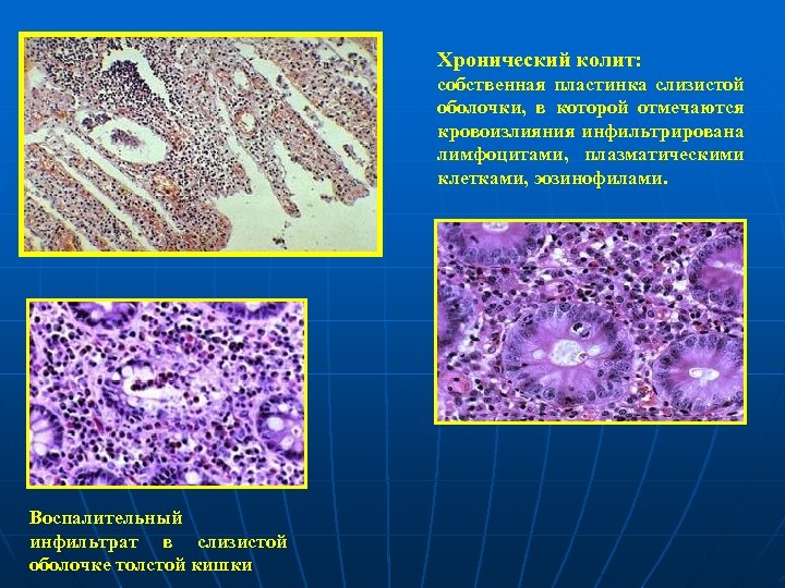 Хронический колит: собственная пластинка слизистой оболочки, в которой отмечаются кровоизлияния инфильтрирована лимфоцитами, плазматическими клетками,