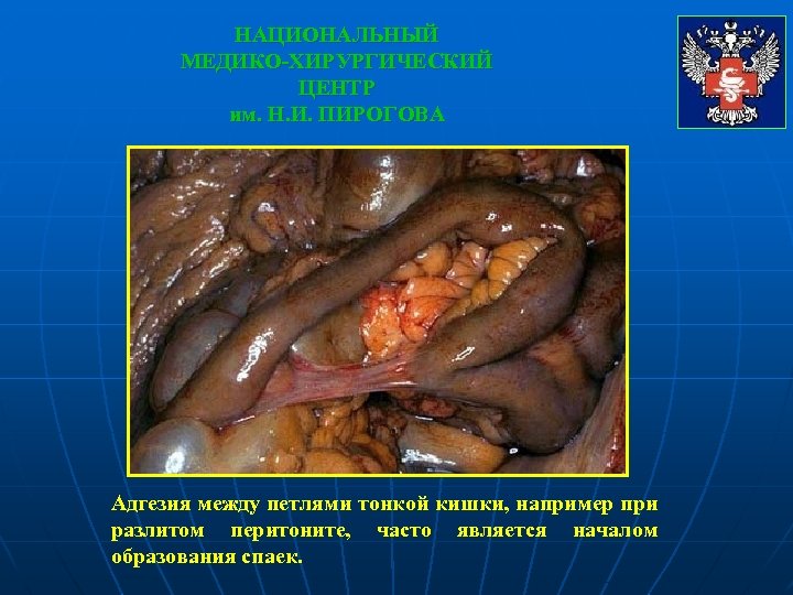 НАЦИОНАЛЬНЫЙ МЕДИКО-ХИРУРГИЧЕСКИЙ ЦЕНТР им. Н. И. ПИРОГОВА Адгезия между петлями тонкой кишки, например при