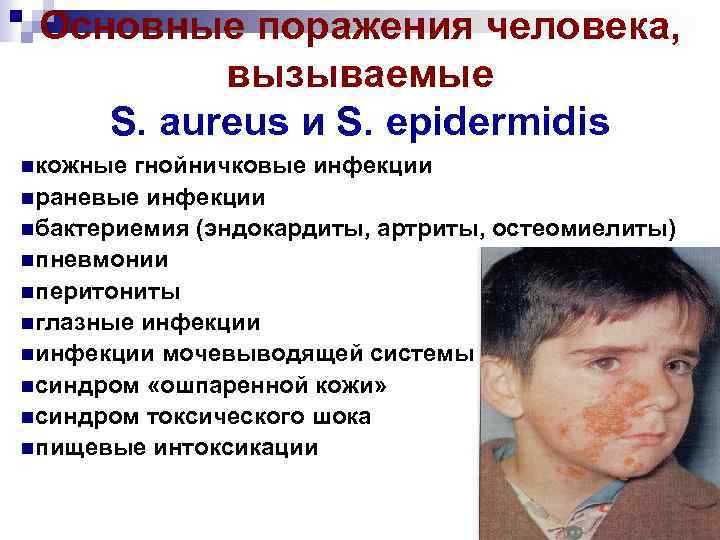 Основные поражения человека, вызываемые S. aureus и S. epidermidis кожные гнойничковые инфекции раневые инфекции