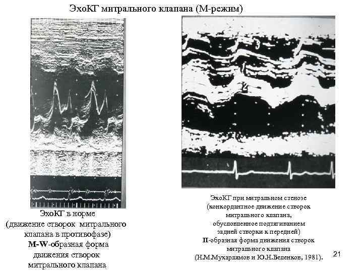 Эхо. КГ митрального клапана (М-режим) Эхо. КГ в норме (движение створок митрального клапана в