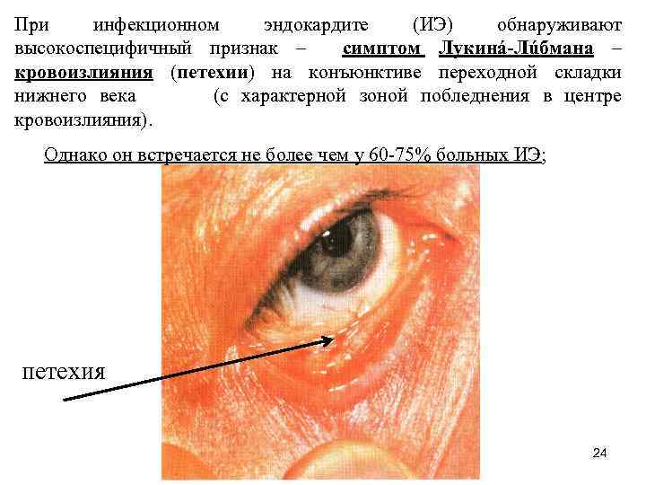 При инфекционном эндокардите (ИЭ) обнаруживают высокоспецифичный признак – симптом Лукинá-Лúбмана – кровоизлияния (петехии) на