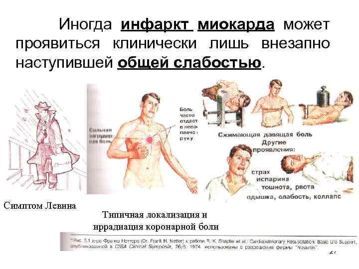 Иногда инфаркт миокарда может проявиться клинически лишь внезапно наступившей общей слабостью. Симптом Левина Типичная