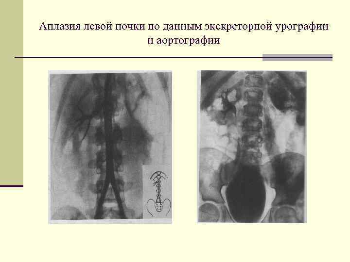 Аплазия левой почки по данным экскреторной урографии и аортографии 