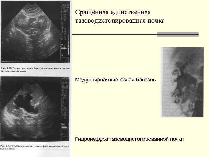 Сращённая единственная тазоводистопированная почка Медуллярная кистозная болезнь Гидронефроз тазоводистопированной почки 