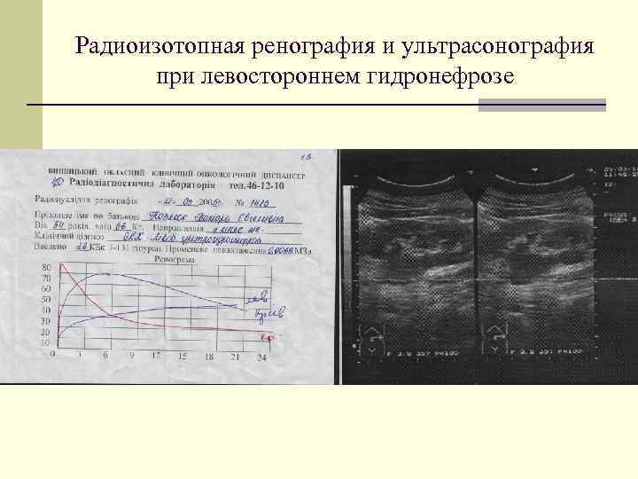 Радиоизотопная ренография и ультрасонография при левостороннем гидронефрозе 