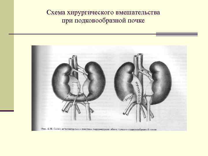 Схема хирургического вмешательства при подковообразной почке 