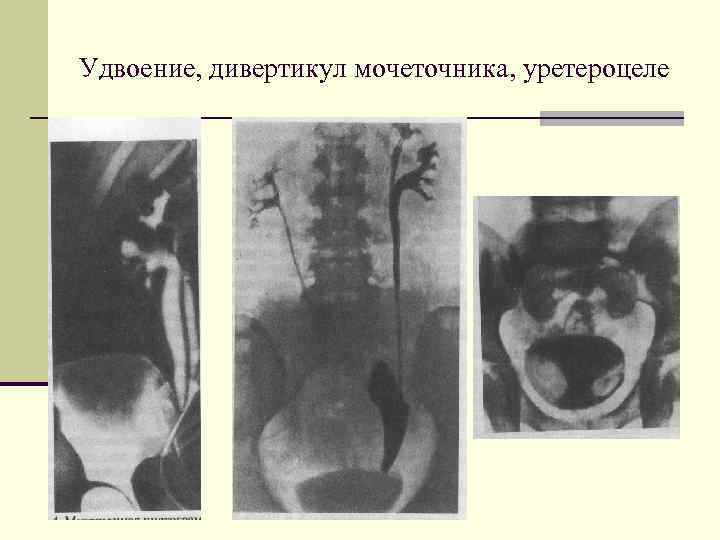 Удвоение, дивертикул мочеточника, уретероцеле 