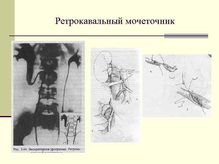 Аномалии развития мочеполовой