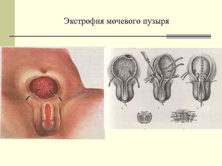 Экстрофия мочевого пузыря 