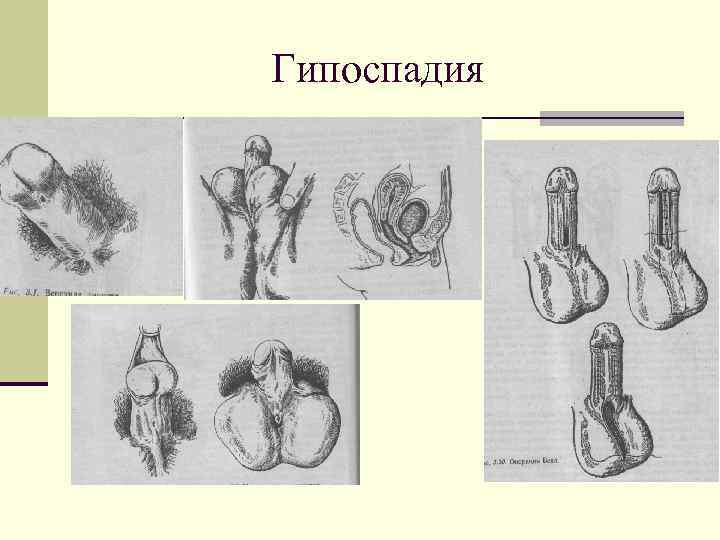 Гипоспадия 