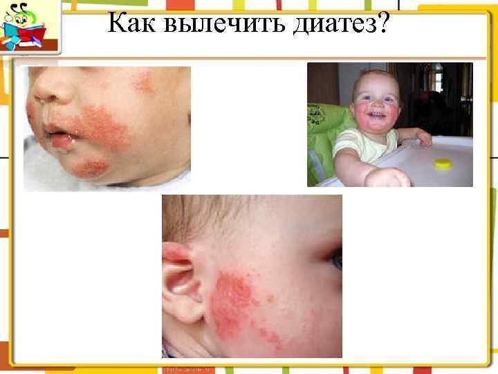 Как вылечить диатез? 