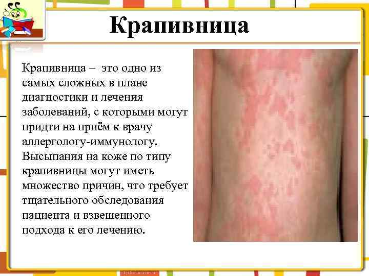 Крапивница – это одно из самых сложных в плане диагностики и лечения заболеваний, с