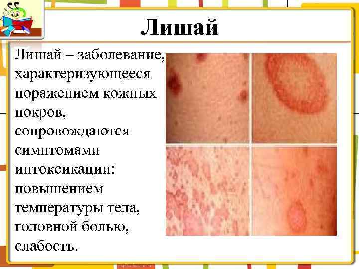 Лишай – заболевание, характеризующееся поражением кожных покров, сопровождаются симптомами интоксикации: повышением температуры тела, головной