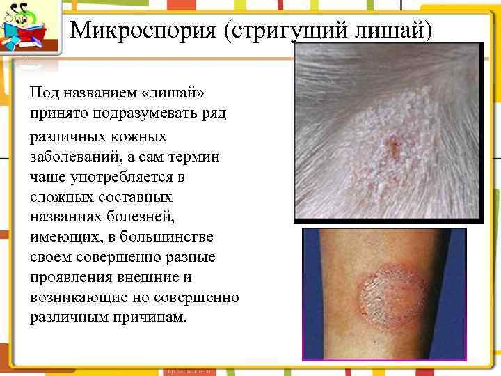 Микроспория (стригущий лишай) Под названием «лишай» принято подразумевать ряд различных кожных заболеваний, а сам