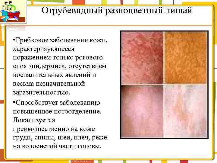 Отрубевидный разноцветный лишай • Грибковое заболевание кожи, характеризующееся поражением только рогового слоя эпидермиса, отсутствием