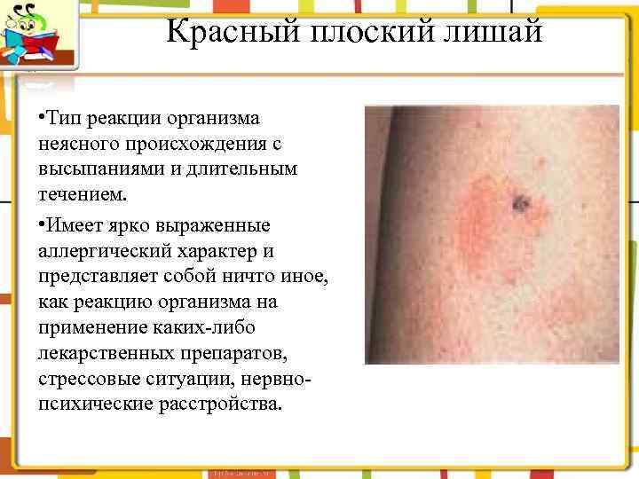 Красный плоский лишай • Тип реакции организма неясного происхождения с высыпаниями и длительным течением.