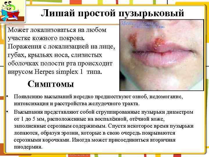 Лишай простой пузырьковый Может локализоваться на любом участке кожного покрова. Поражения с локализацией на