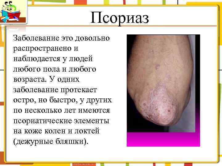 Псориаз Заболевание это довольно распространено и наблюдается у людей любого пола и любого возраста.