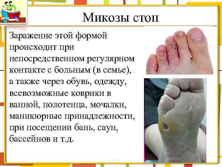 Микозы стоп Заражение этой формой происходит при непосредственном регулярном контакте с больным (в семье),