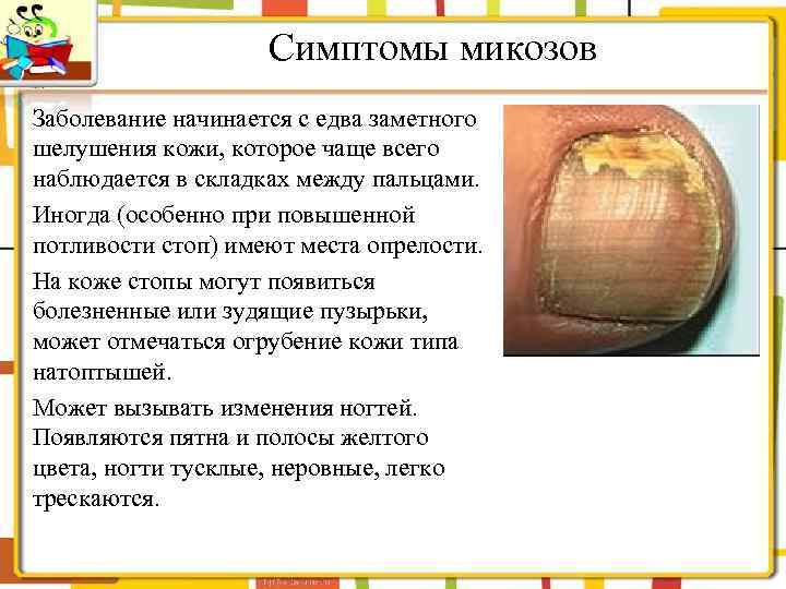 Симптомы микозов Заболевание начинается с едва заметного шелушения кожи, которое чаще всего наблюдается в