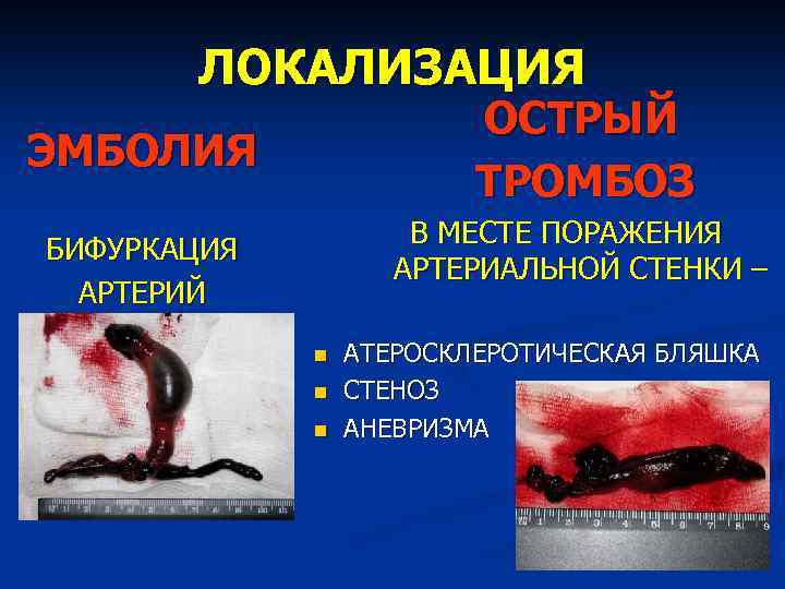 ЛОКАЛИЗАЦИЯ ОСТРЫЙ ТРОМБОЗ ЭМБОЛИЯ В МЕСТЕ ПОРАЖЕНИЯ АРТЕРИАЛЬНОЙ СТЕНКИ – БИФУРКАЦИЯ АРТЕРИЙ n n