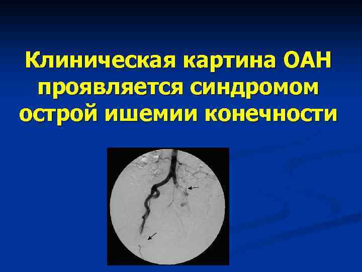 Клиническая картина острой обтурационной толстокишечной непроходимости характеризуется