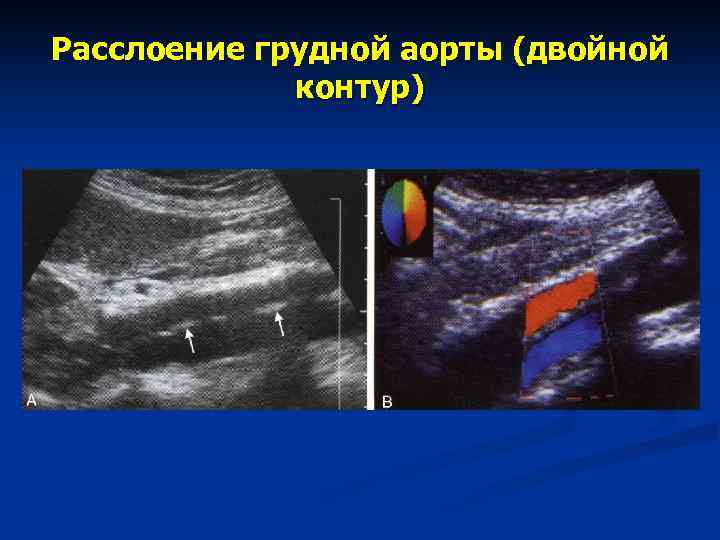 Двойной контур плода. Двойной контур головки плода. Двойной контур. Двойной контур головы у плода.