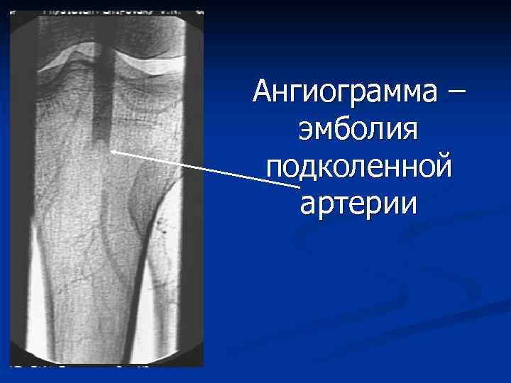 Острая артериальная непроходимость нижних конечностей презентация