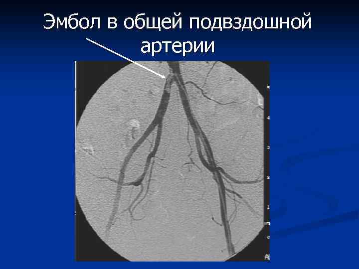 Состав эмболов схема